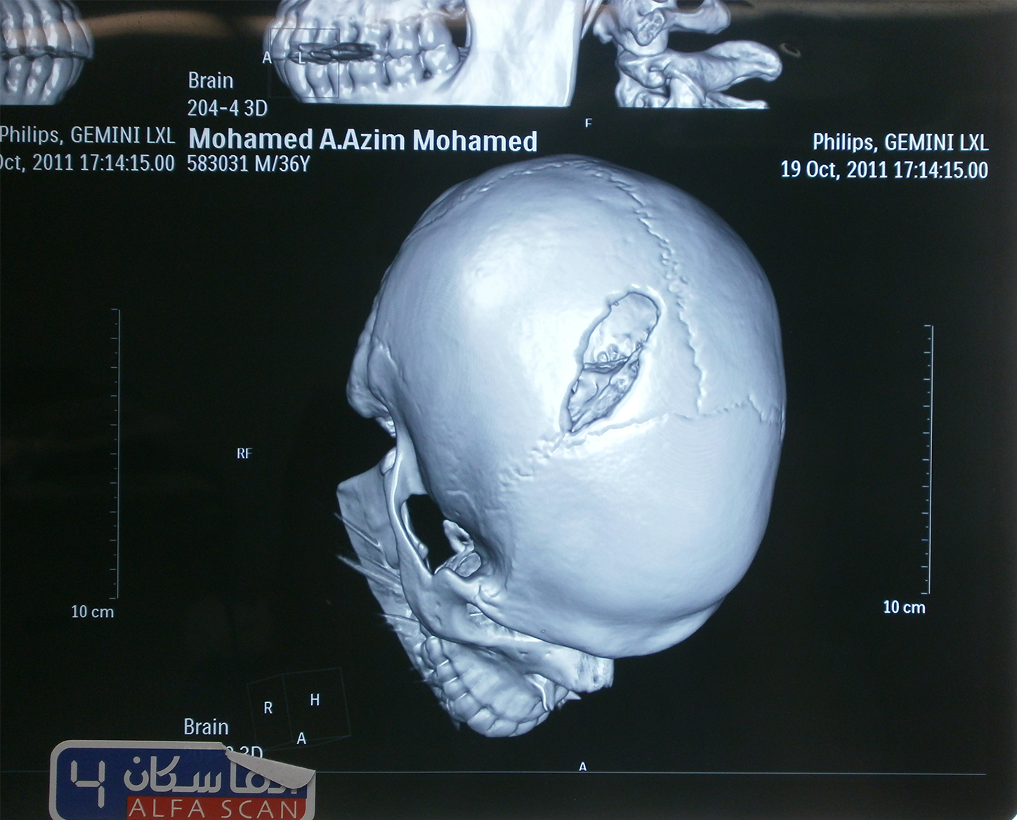 اشعة مقطعية تظهر كسر بالجمجمة